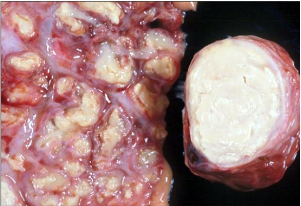 Pulmão e linfonodo bovino infectados pela tuberculose