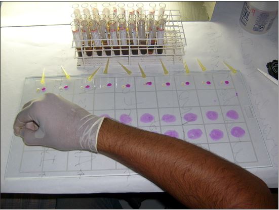 Mistura entre o soro do sangue e o AAT 