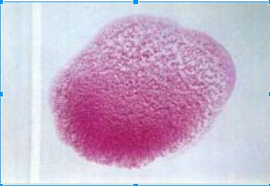 Exemplo de resultado de exame positivo para brucelose