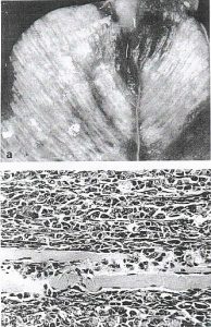 distrofia-nutricional-doenca-do-musculo-branco