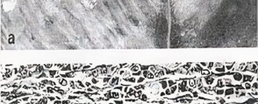 distrofia-nutricional-doenca-do-musculo-branco1