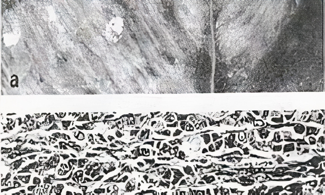 distrofia-nutricional-doenca-do-musculo-branco1