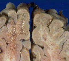 Cérebro de bovino com vaca louca